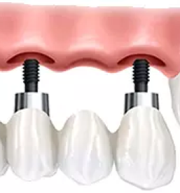 Kvalitetna izdelava implantatov maribor