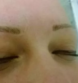 Lasersko odstranjevanje dlak sencur