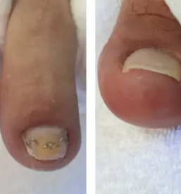 Medicinska pedikura celje