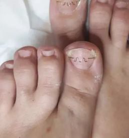 ugodna medicinska pedikura koroska