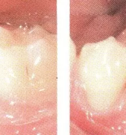 Nevidni zobni aparat ljubljana