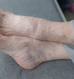 Sanacija otiscancev vrhnika