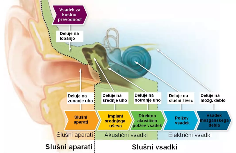 Slušni vsadki Cochlear