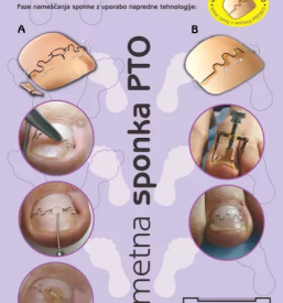 Terapije glivicnih obolenj na nohtih koroska