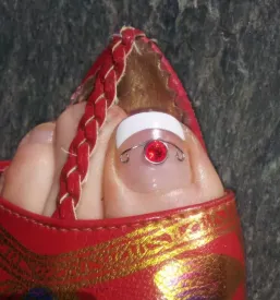 Terapije vrascenih nohtov
