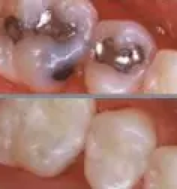 Ugodno peskanje zob ljubljana