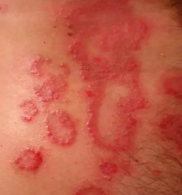 Zdravljenje kožnih bolezni Maribor