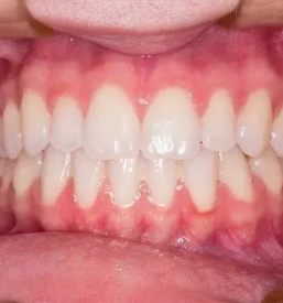 Zdravljenje ustnih bolezni portoroz