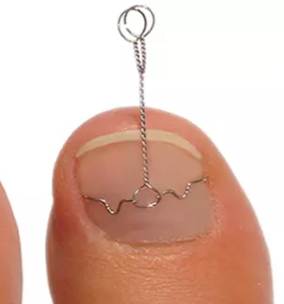 Zdravljenje vrascenih nohtov dolenjska