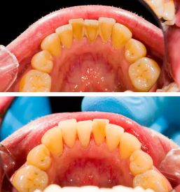 Zdravljenje zobnih bolezni posavje