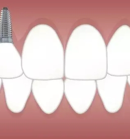 Zobna protetika primorska