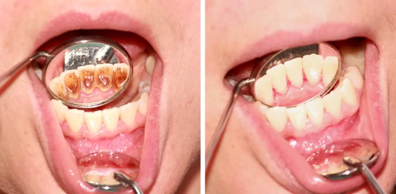 zobozdravniški pregled
