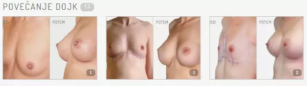 S kvalitetnim povečanjem prsi do boljše samozavesti