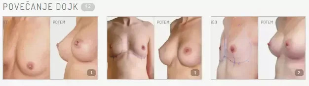 S kvalitetnim povečanjem prsi do boljše samozavesti