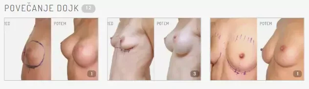 Kvalitetno povečanje prsi v Sloveniji