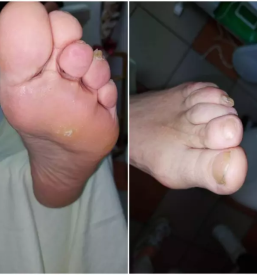 Namescanje sponke za vrascene nohte