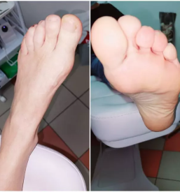 Namescanje sponke za vrascene nohte