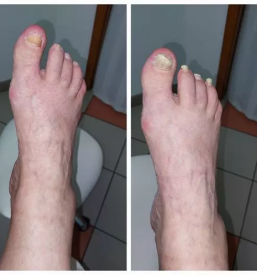 Namescanje sponke za vrascene nohte