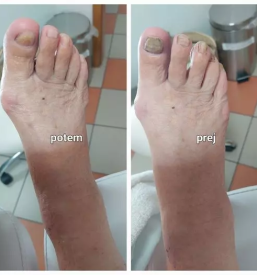 Namescanje sponke za vrascene nohte