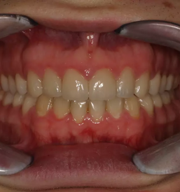 Učinkovit nevidni zobni aparat Clear Aligner Murska Sobota