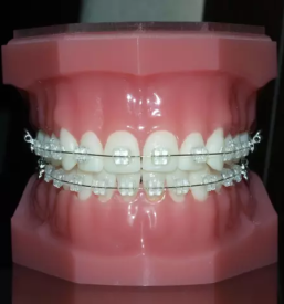 Zobni aparat invisalign Murska Sobota