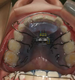 Zobni aparat invisalign Murska Sobota