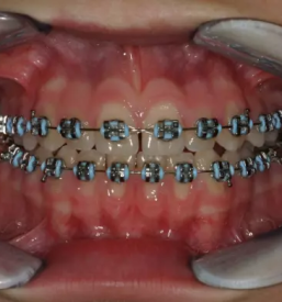 Kvalitetna ortodontija murska sobota