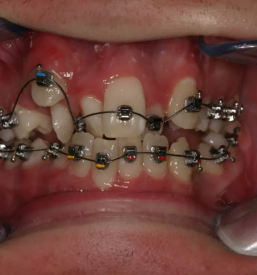 Orthas fiksna tehnika samoligirajoci nosilci