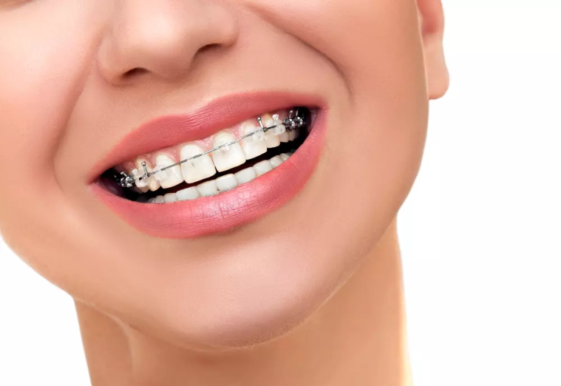 Iščete odličnega ortodonta v Murski Soboti? Vabljeni v ortodontijo ORTHAS!