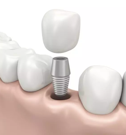 Zobni implantati ptuj