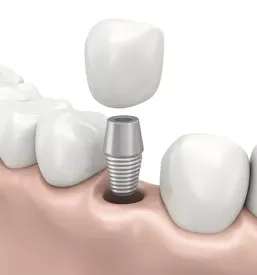 Zobni implantati ptuj