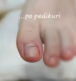 Pedikerka