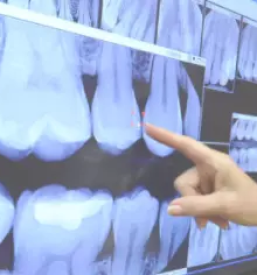 Lasersko zdravljenje parodontoze Ivančna Gorica