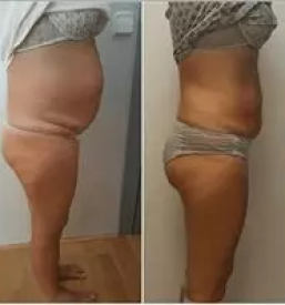 Kriolipoliza maribor