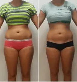 Kriolipoliza maribor