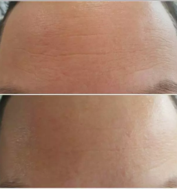 Kriolipoliza maribor