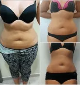 Kriolipoliza maribor