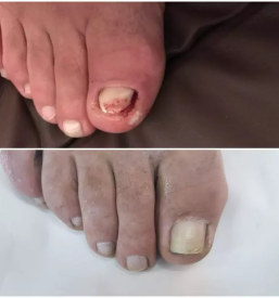 Medicinska pedikura Maribor