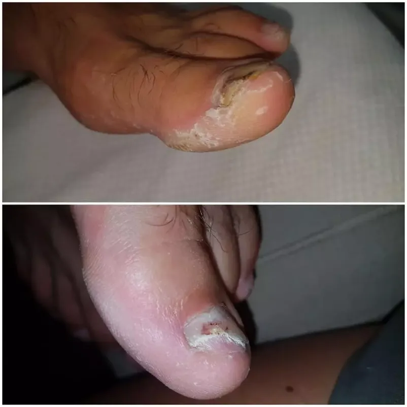 Medicinska pedikura Radlje ob Dravi
