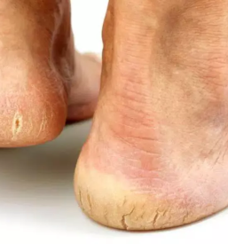 Medicinska pedikura ljubljana siska