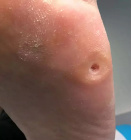 Medicinska pedikura ljubljana siska