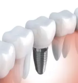 Strojno sirjenje koreninskih kanalov ljubljana