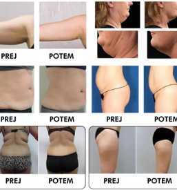 Uv lifting obraza maribor okolica