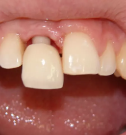 Implantati ljubljana okolica