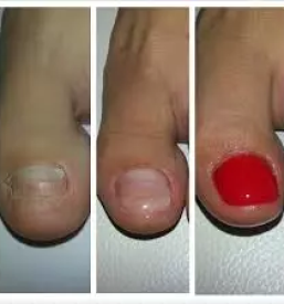 Nohtna protetika krsko