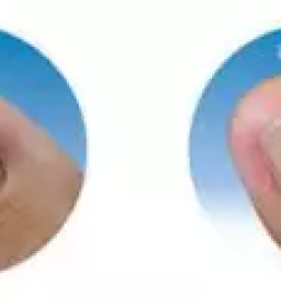 Nohtna protetika krsko