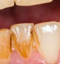 Immediate help for mucositis slovenia