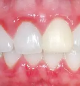 Immediate help for mucositis slovenia