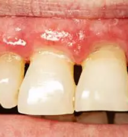 Immediate help for periodontitis slovenia