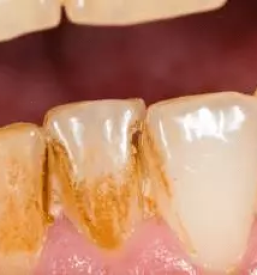 Notbehandlung bei parodontose slowenien